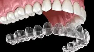 Dentapolitan Invisalign tedavisi